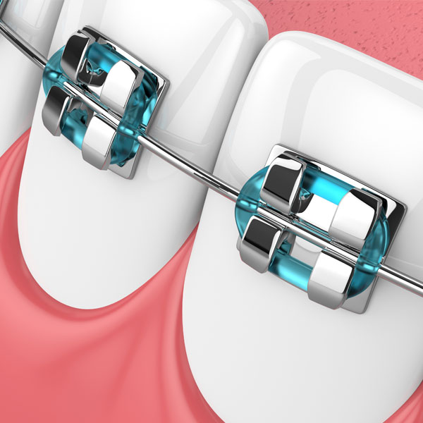 3d-render-of-custom-orthodontic-braces - Boss Orthodontics