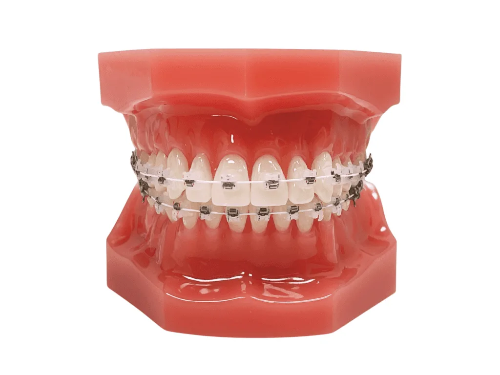 Ceramic Braces Clear Braces, Ceramic Braces, White Braces, orthodontic office