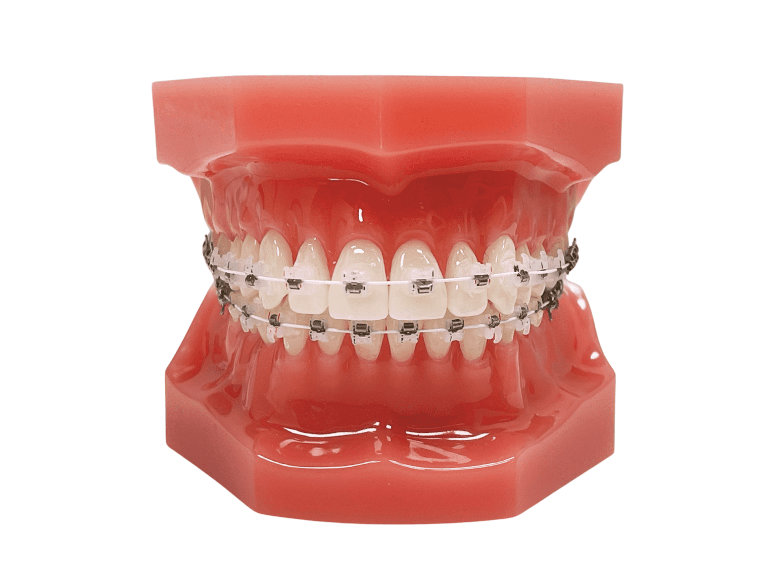 Braces In Bee Cave, Kyle, Austin TX Selftightening braces