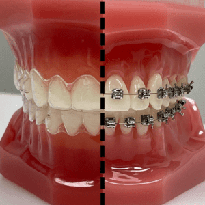 Aligners vs Braces, Hybrid Treatment
