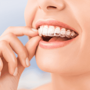 Clear Retainers or Aligners