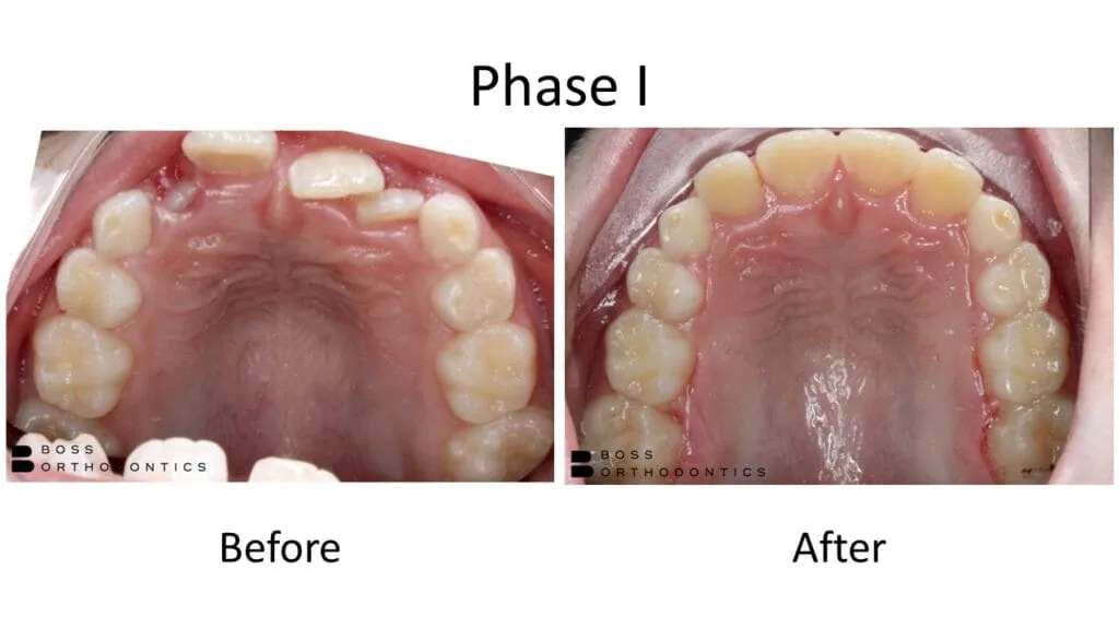 Phase I Orthodontic Before and After, Orthodontist Before and after 1