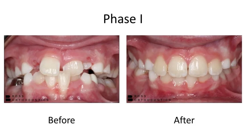 Phase I Orthodontic Before and After, Orthodontist Before and after 2