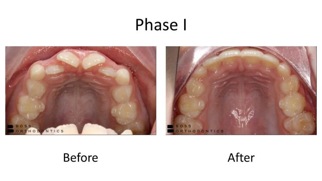 Phase I Orthodontic Before and After, Orthodontist Before and after 3