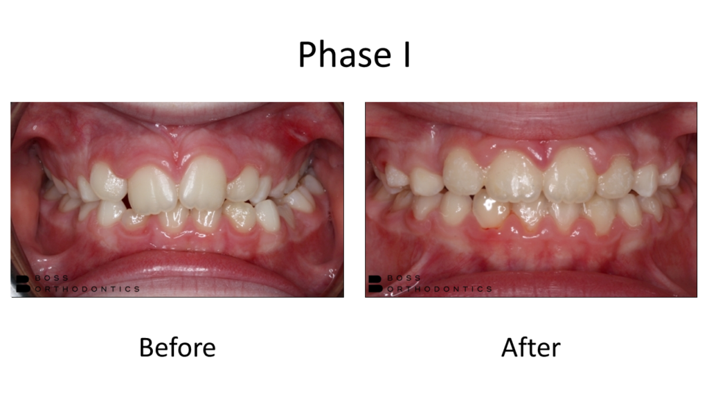 Phase I before and after transformation, crossbite correction