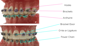 Parts of Braces