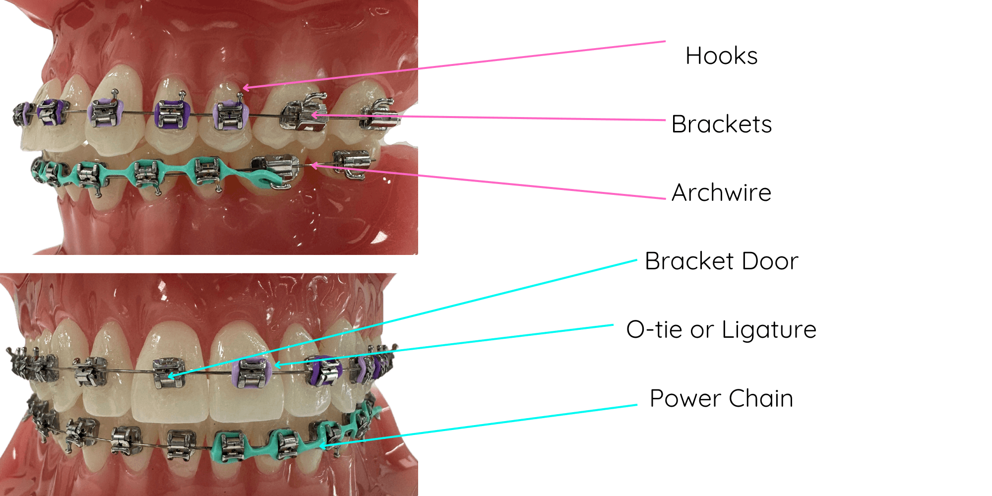 Different Parts of Braces