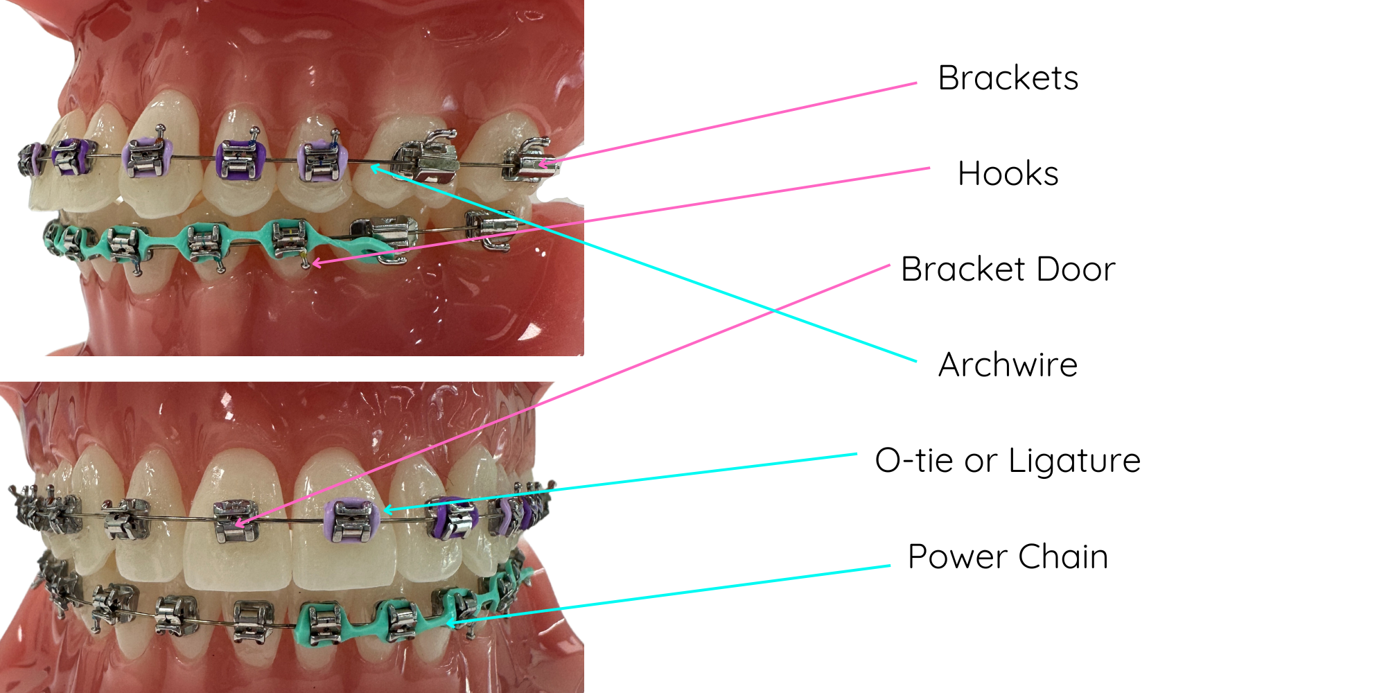 Brackets Hooks Bracket Door Archwire O-tie or Ligature Power Chain - Boss  Orthodontics