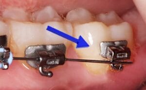 wire pops out, wire comes out of braces
