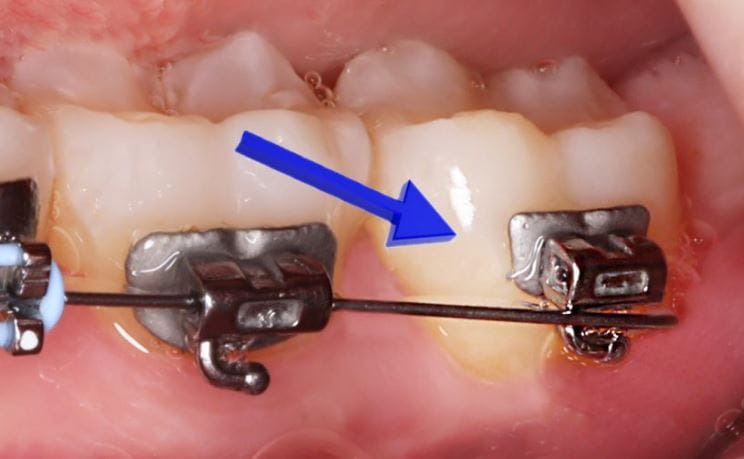 wire pops out, wire comes out of braces