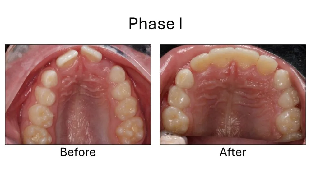 Phase I Orthodontic Before and After, Orthodontist Before and after 10