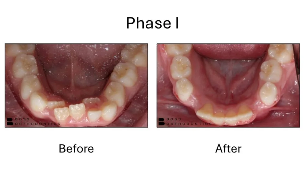 Phase I Orthodontic Before and After, Orthodontist Before and after 11