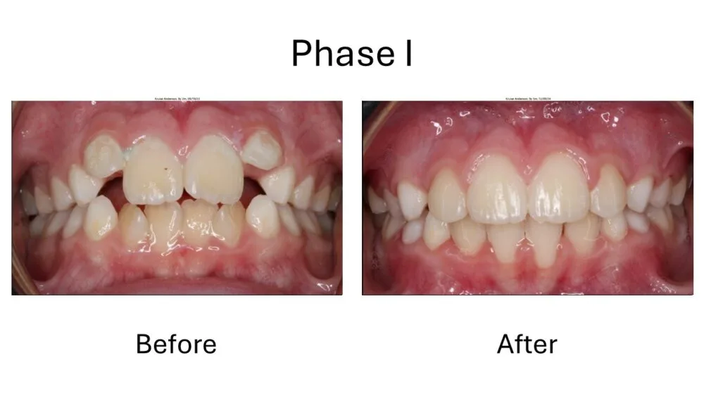 Phase I Orthodontic Before and After, Orthodontist Before and after 12