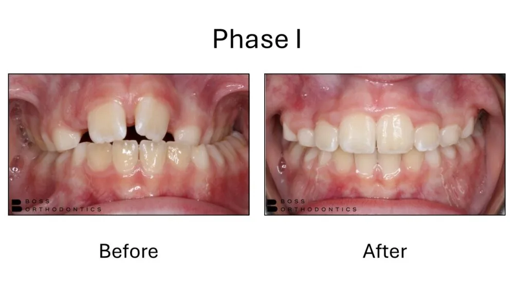 Phase I Orthodontic Before and After, Orthodontist Before and after 13