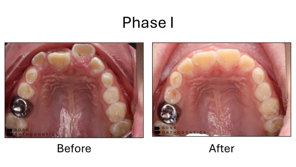 Phase I Orthodontic Before and After, Orthodontist Before and after 14