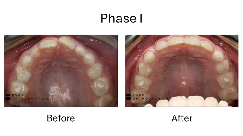 Phase I Orthodontic Before and After, Orthodontist Before and after