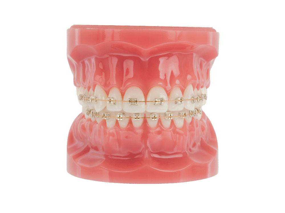 American Orthodontics Iconix Brackets, Esthetic Brackets, Champaign Coating