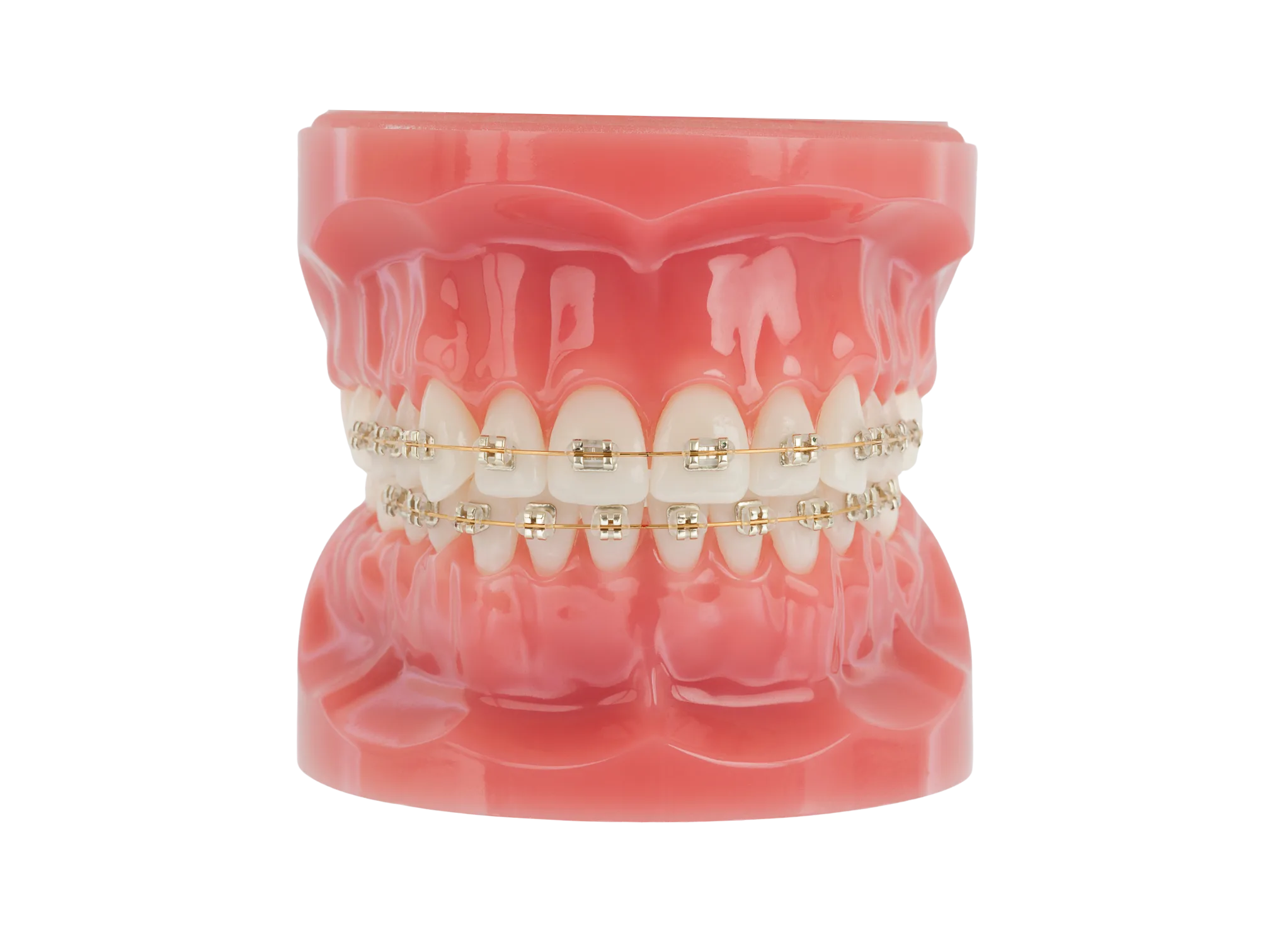 American Orthodontics Iconix Brackets, Esthetic Brackets, Champaign Coating