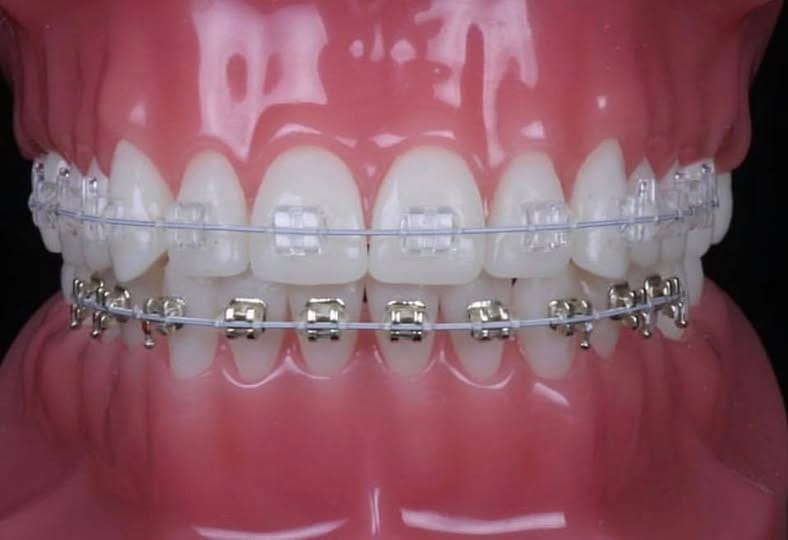 Ceramic upper braces with esthetic metal braces lower (Iconix)