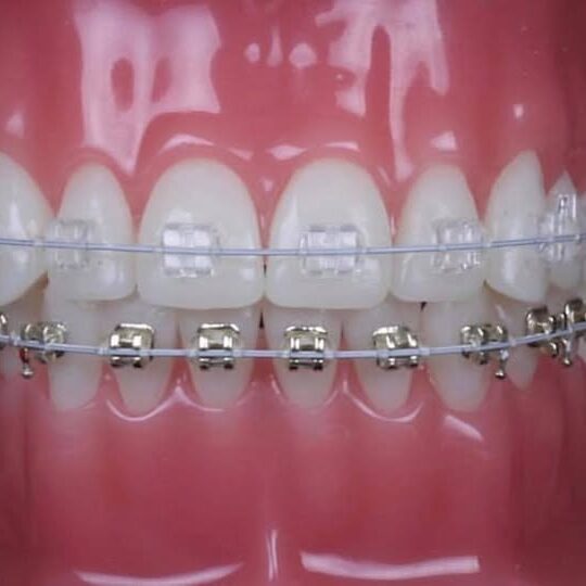 Ceramic upper braces with esthetic metal braces lower (Iconix)