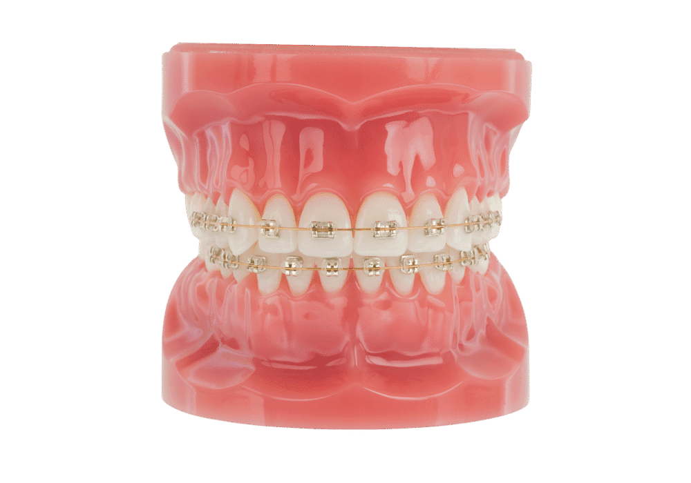 American Orthodontics Iconix Brackets, Esthetic Brackets, Champaign Coating