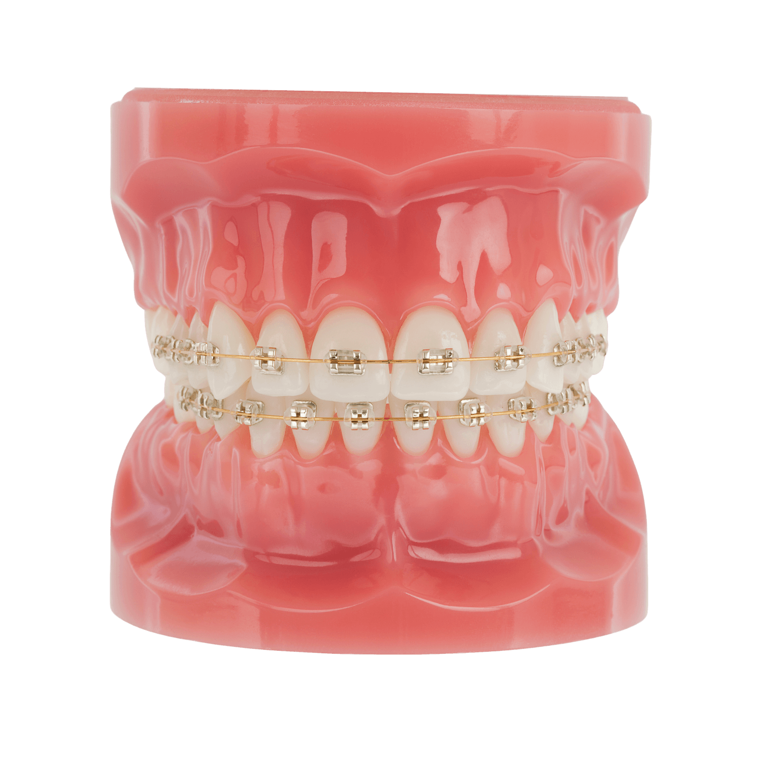 American Orthodontics Iconix Brackets, Esthetic Brackets, Champaign Coating