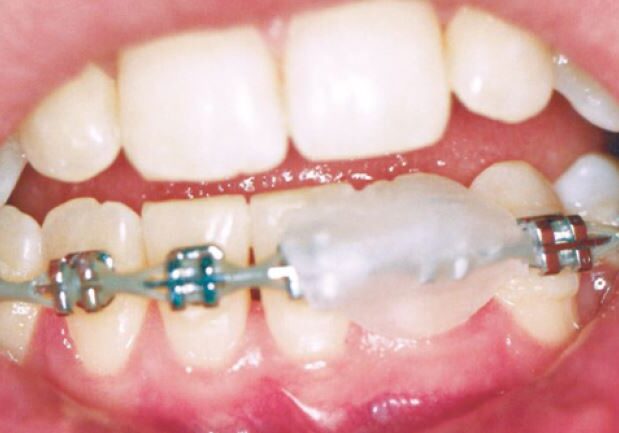 How to Put Wax on Your Braces?