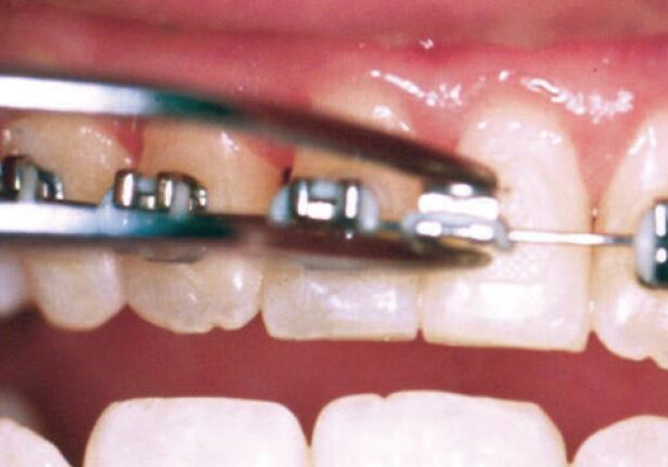 How to Handle Pokey Wires and Home and Other Orthodontic Tips