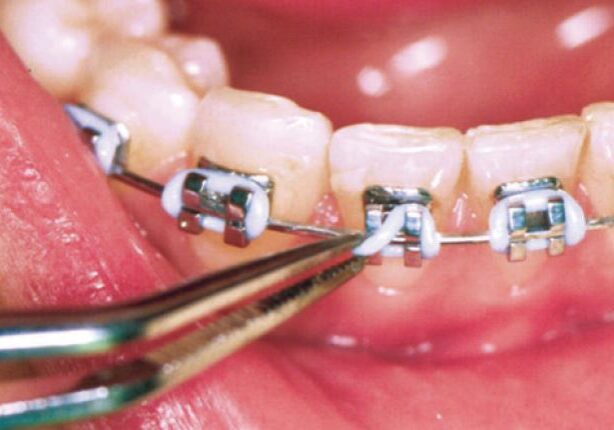 Orthodontic Emergencies - Boss Orthodontics