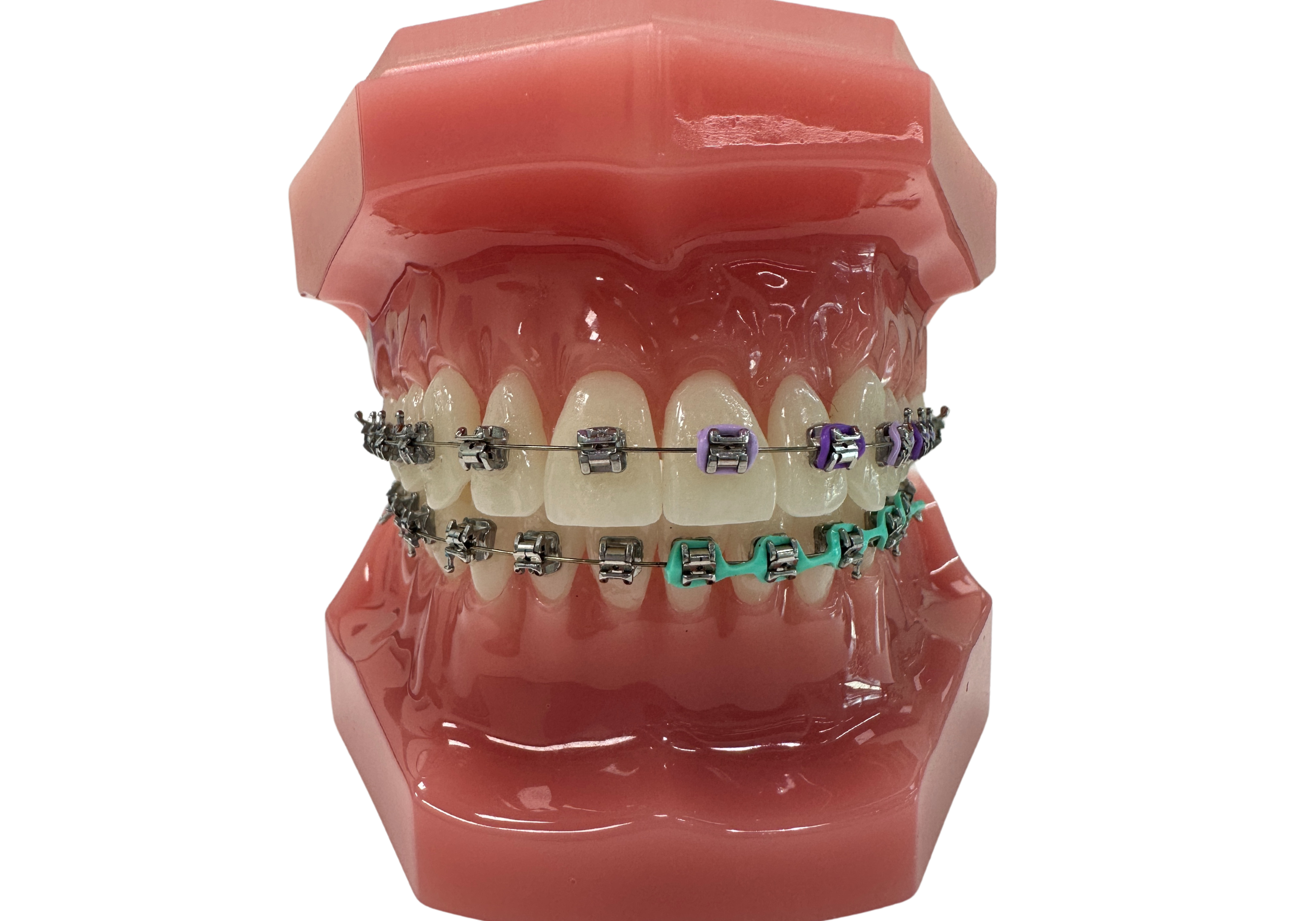 Metal Braces, Self tightening, braces with colors