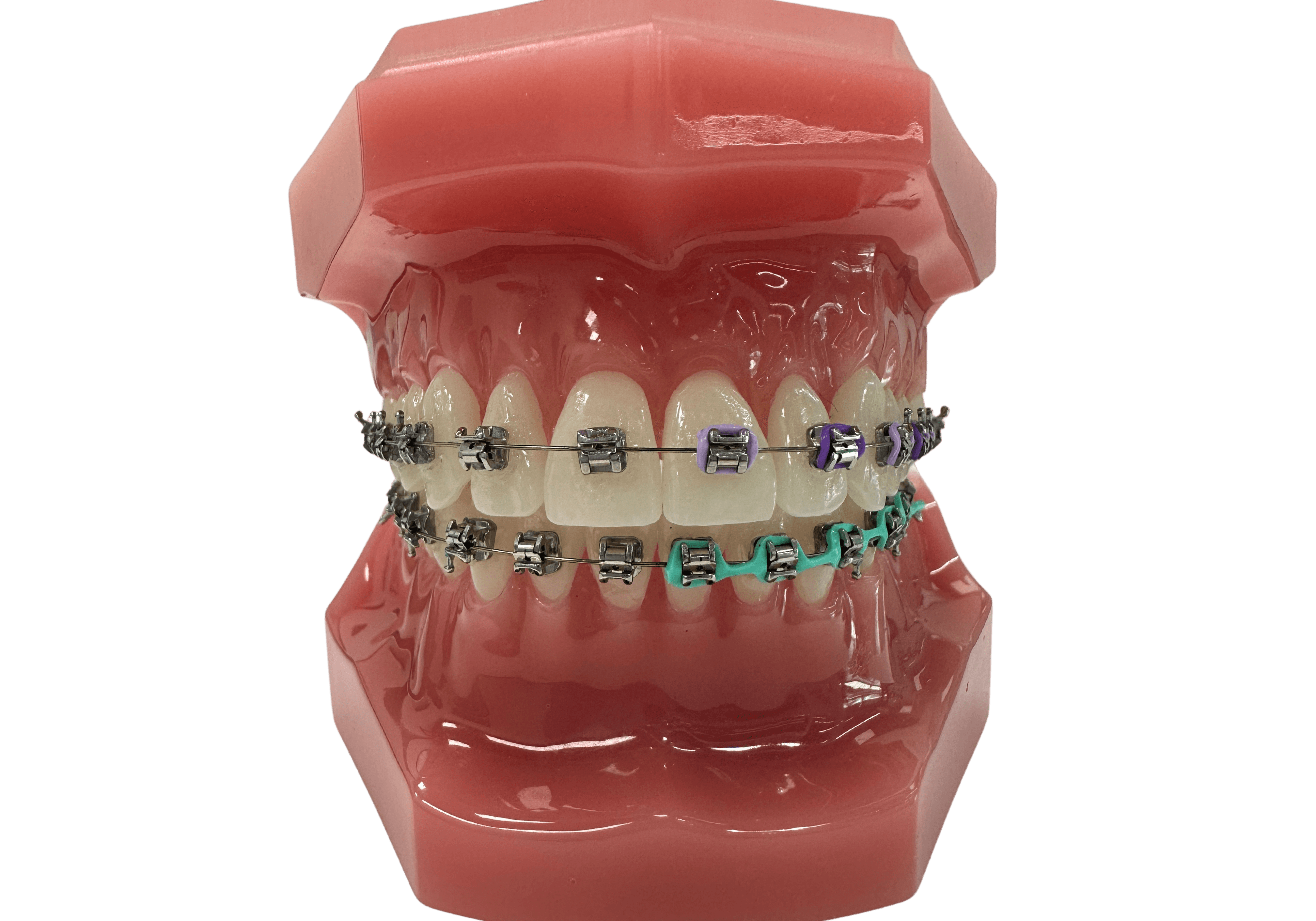 Metal Braces, Self tightening, braces with colors