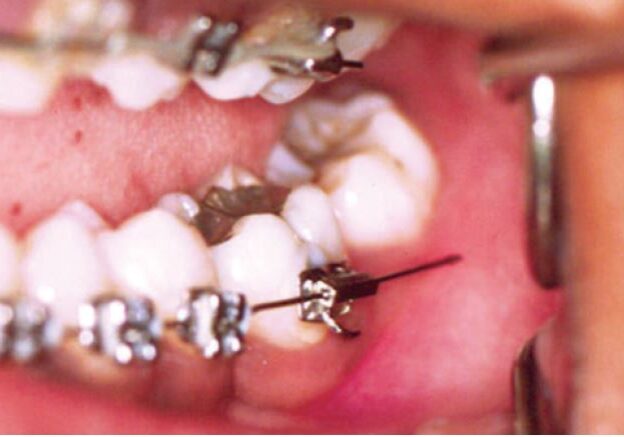 What to do if I Have an Orthodontic Emergency?