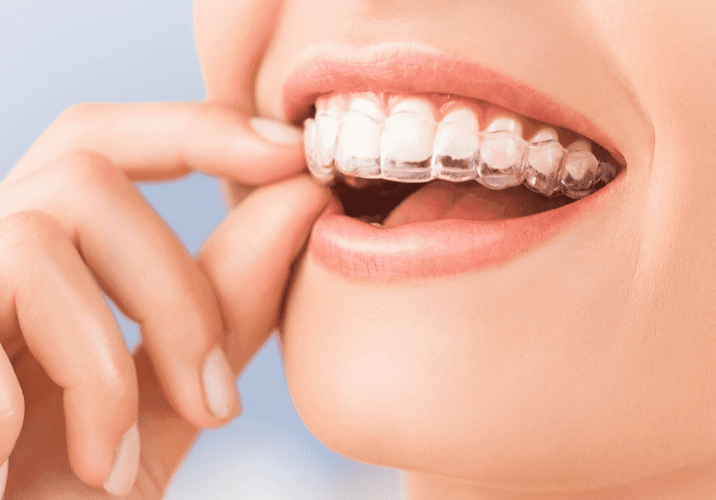 Clear Retainers or Aligners