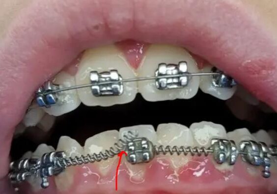 Orthodontic Emergencies - Boss Orthodontics