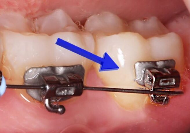 What to do when I have an orthodontic wire sticking out and poking